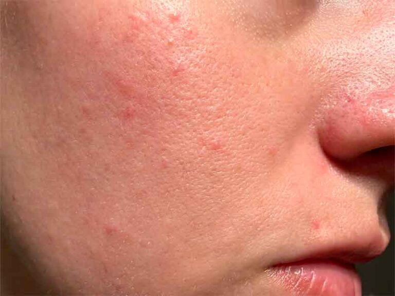 pelle con acne