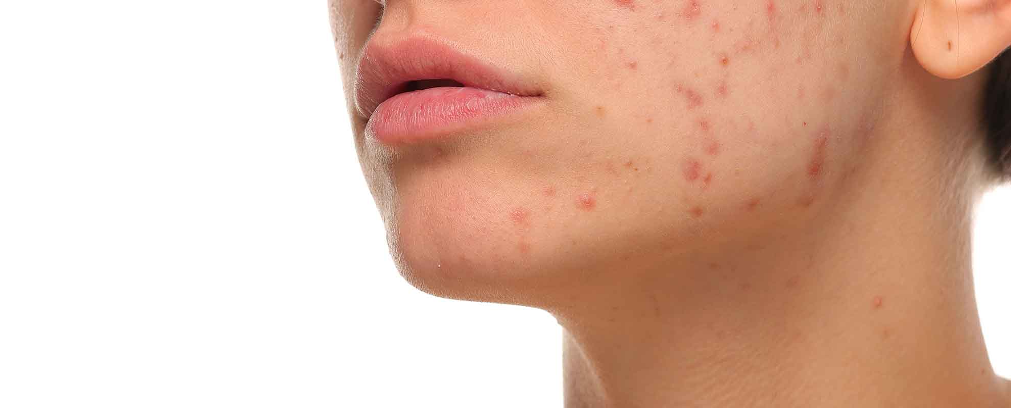trattamenti per pelle acneica